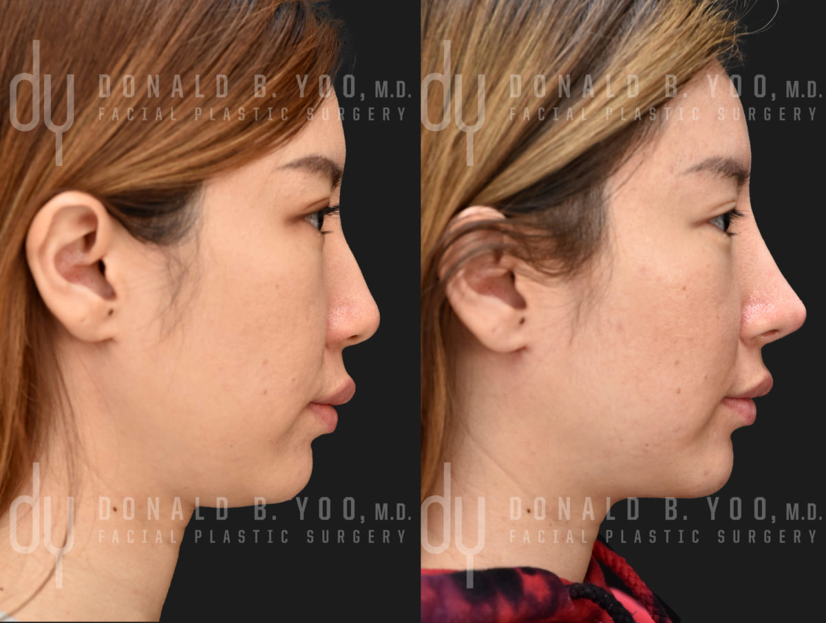 Rhinoplasty and Chin Augmentation before and after - before