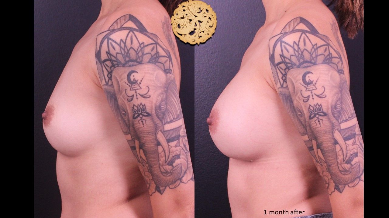 Breast Augmentation before and after - after