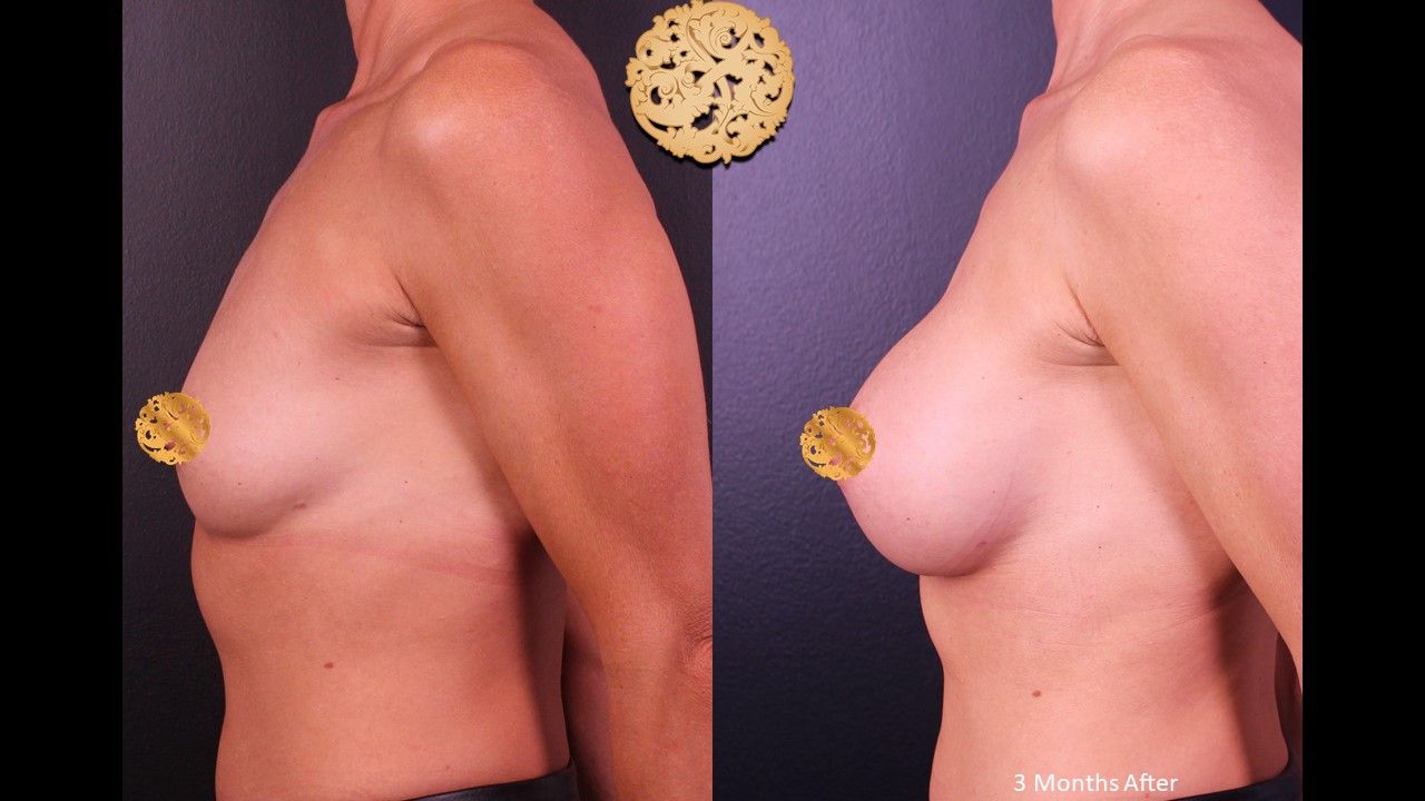 Breast Augmentation before and after - before