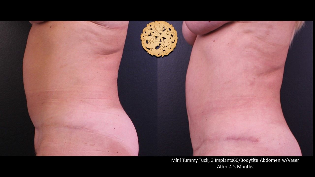 Mini Tummy Tuck before and after - after