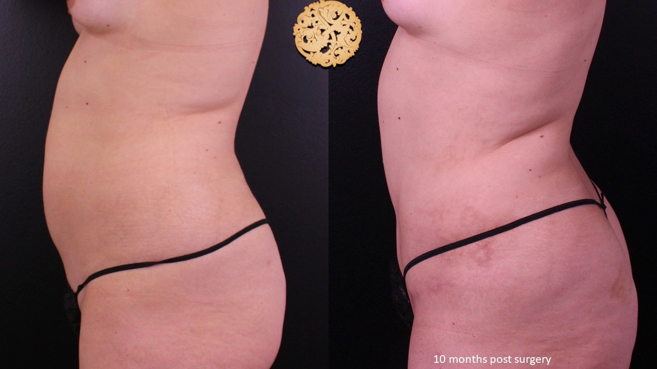 Mini Tummy Tuck before and after - before