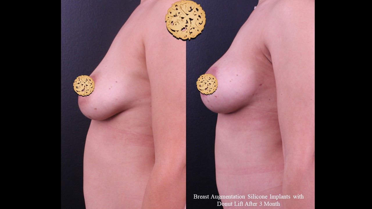 Breast Augmentation before and after - after