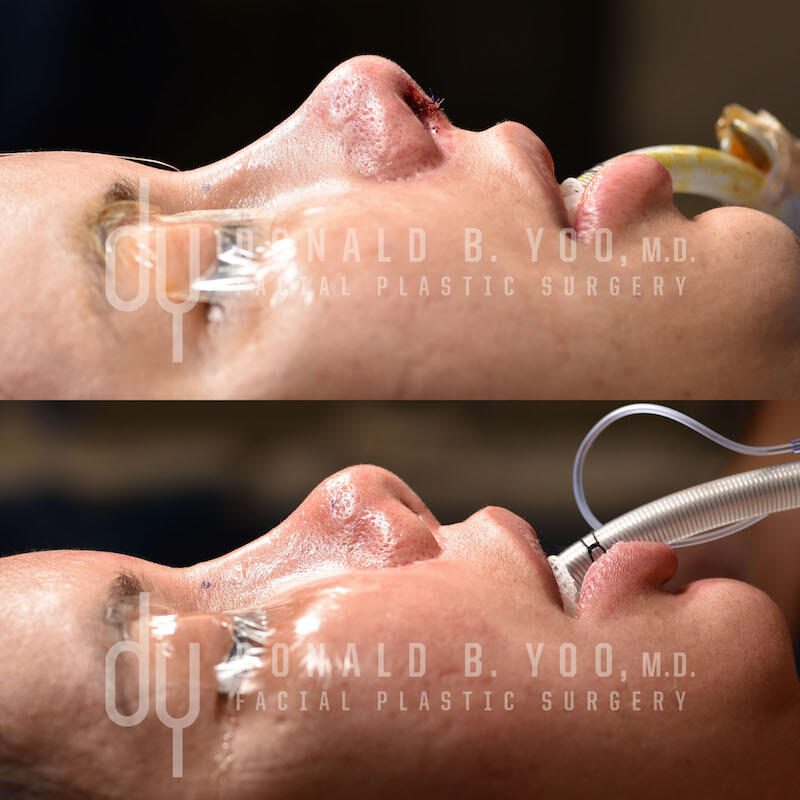 Rhinoplasty before and after - after