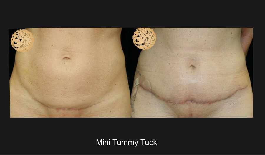 Mini Tummy Tuck before and after - after