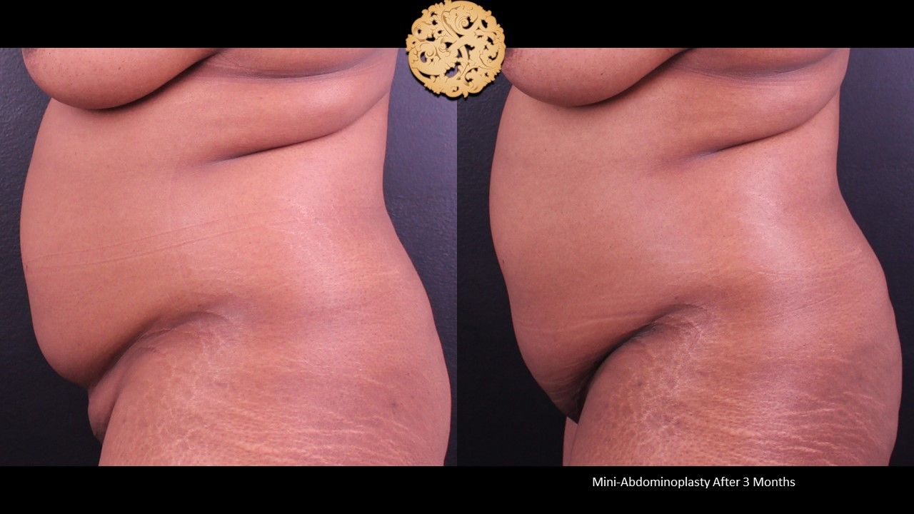 Mini Tummy Tuck before and after - before
