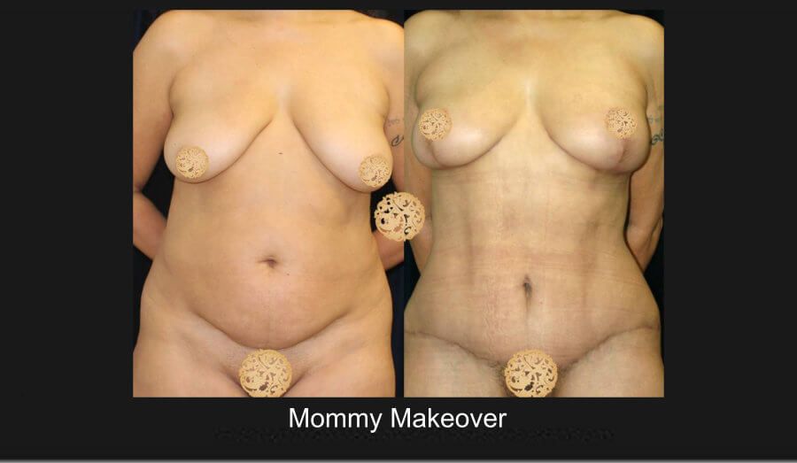 Mommy Makeover before and after - after