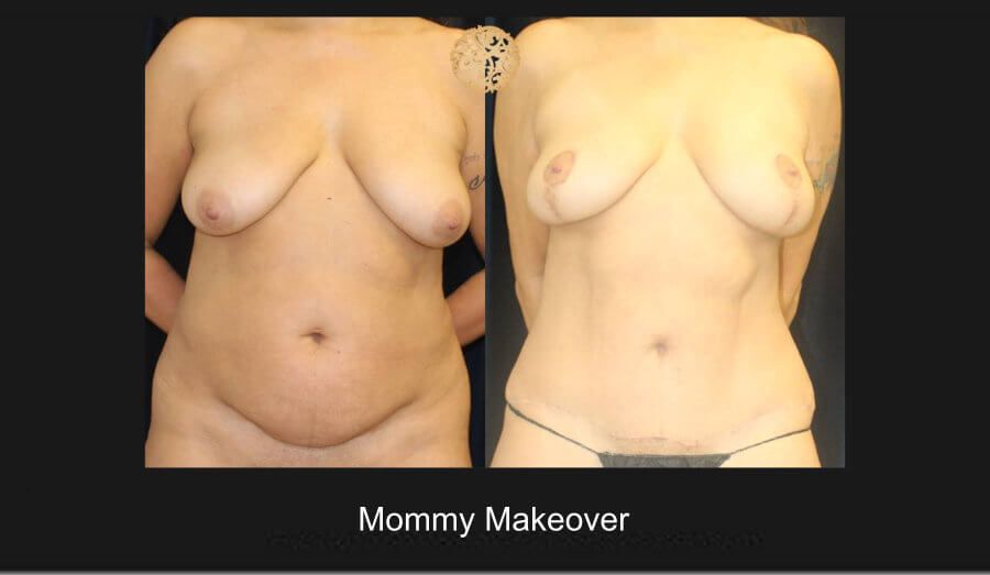 Mommy Makeover before and after - before