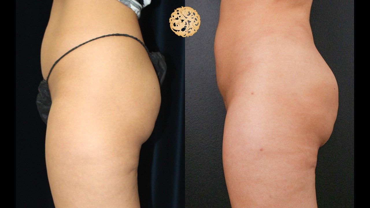 Brazilian Butt Lift before and after - after