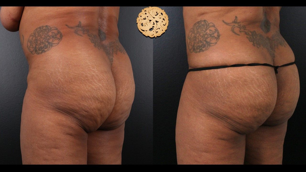 Brazilian Butt Lift before and after - after