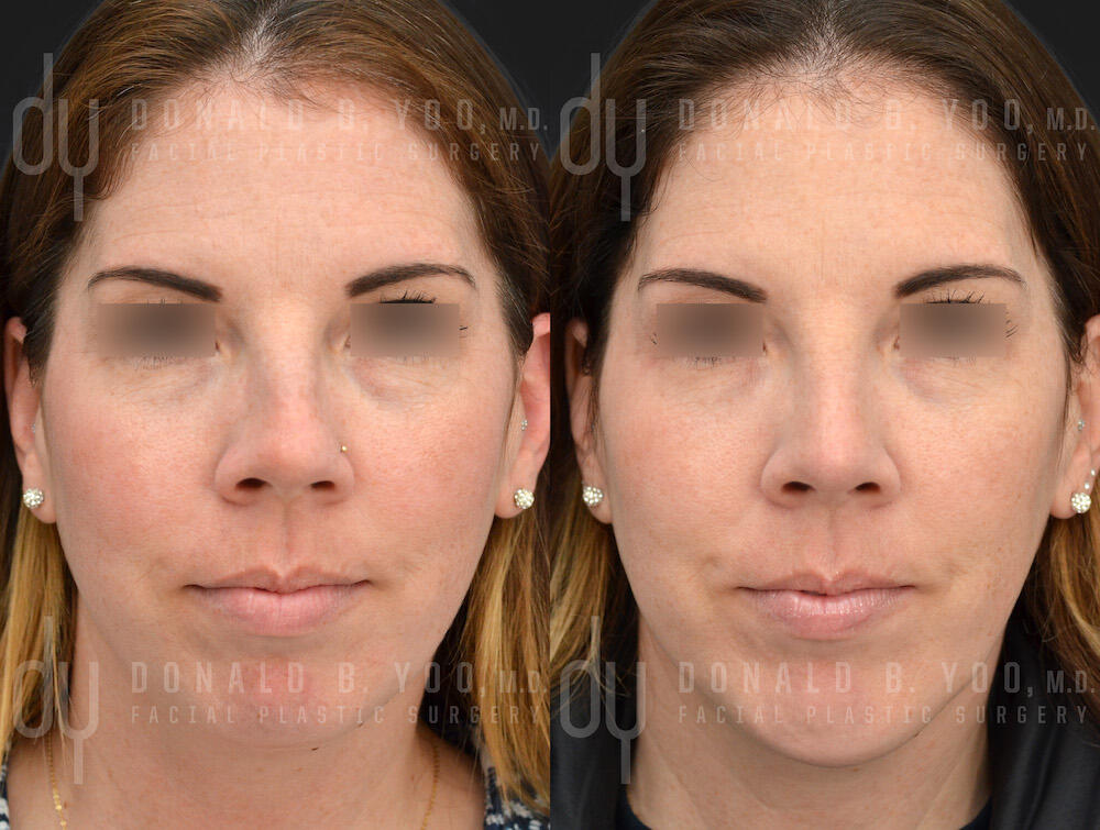 Rhinoplasty and Chin Augmentation before and after - after