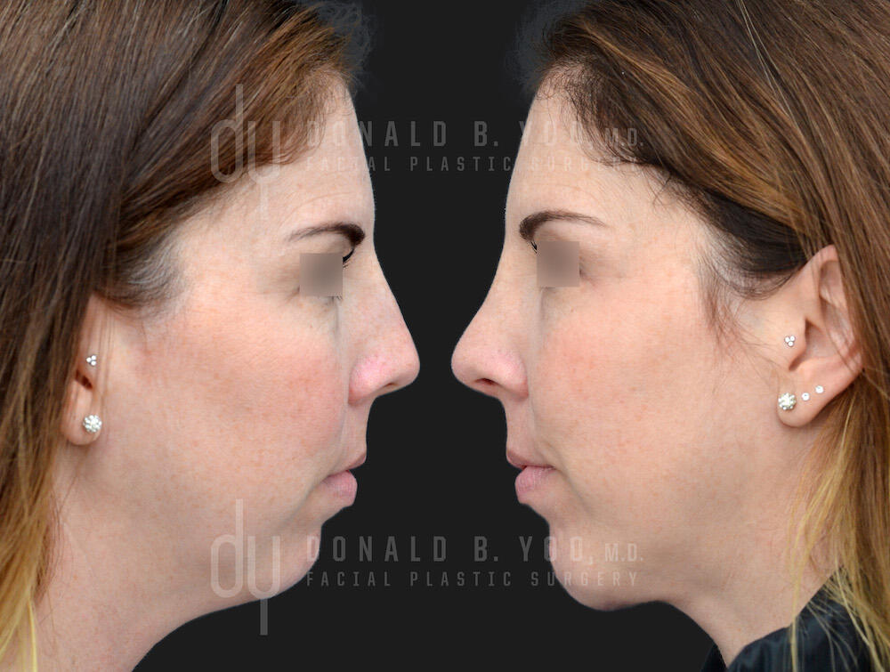 Rhinoplasty and Chin Augmentation before and after - before