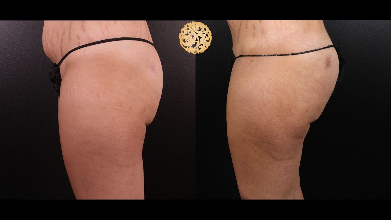Brazilian Butt Lift before and after - after