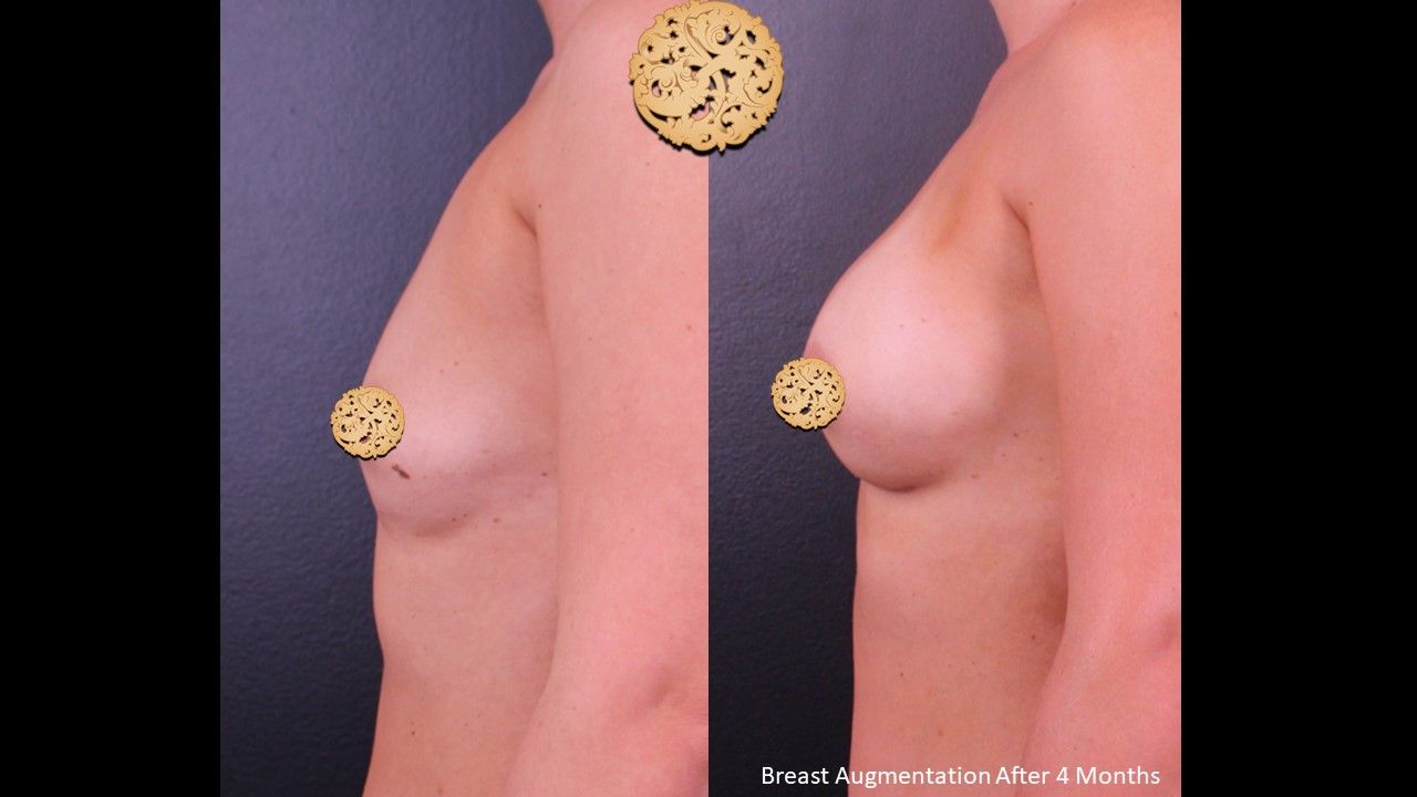Breast Augmentation before and after - after