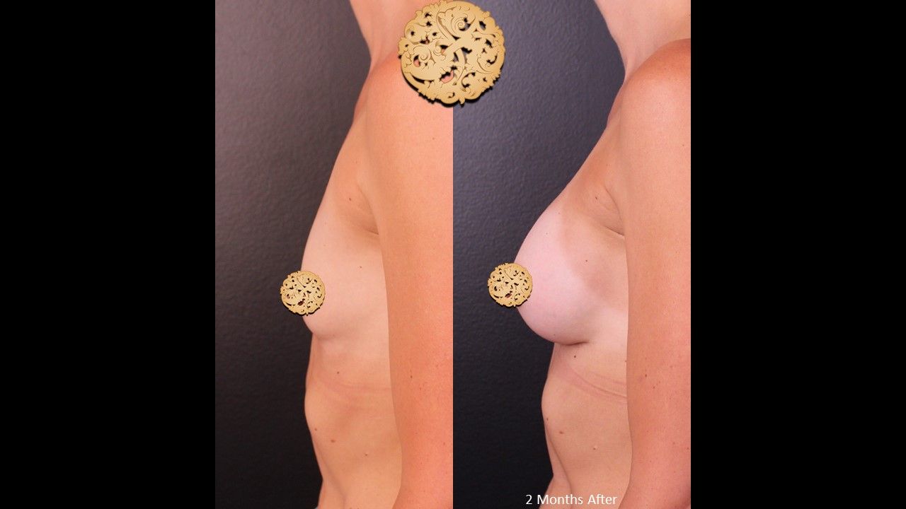 Breast Augmentation before and after - before