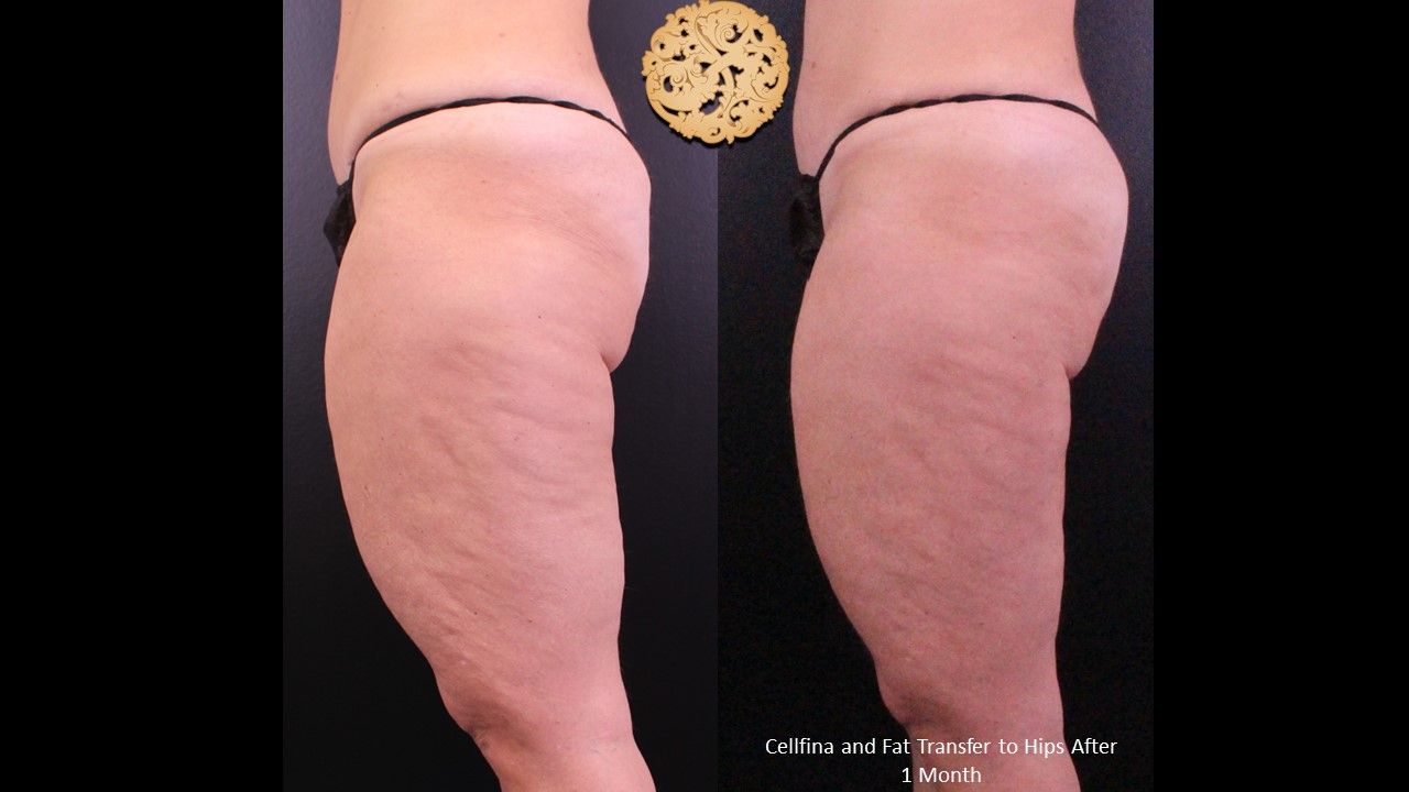 Brazilian Butt Lift before and after - before