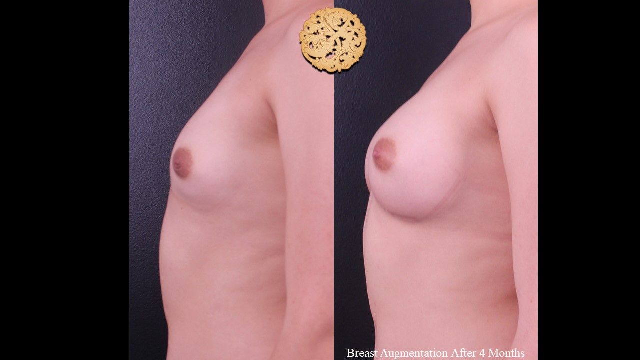 Breast Augmentation before and after - after