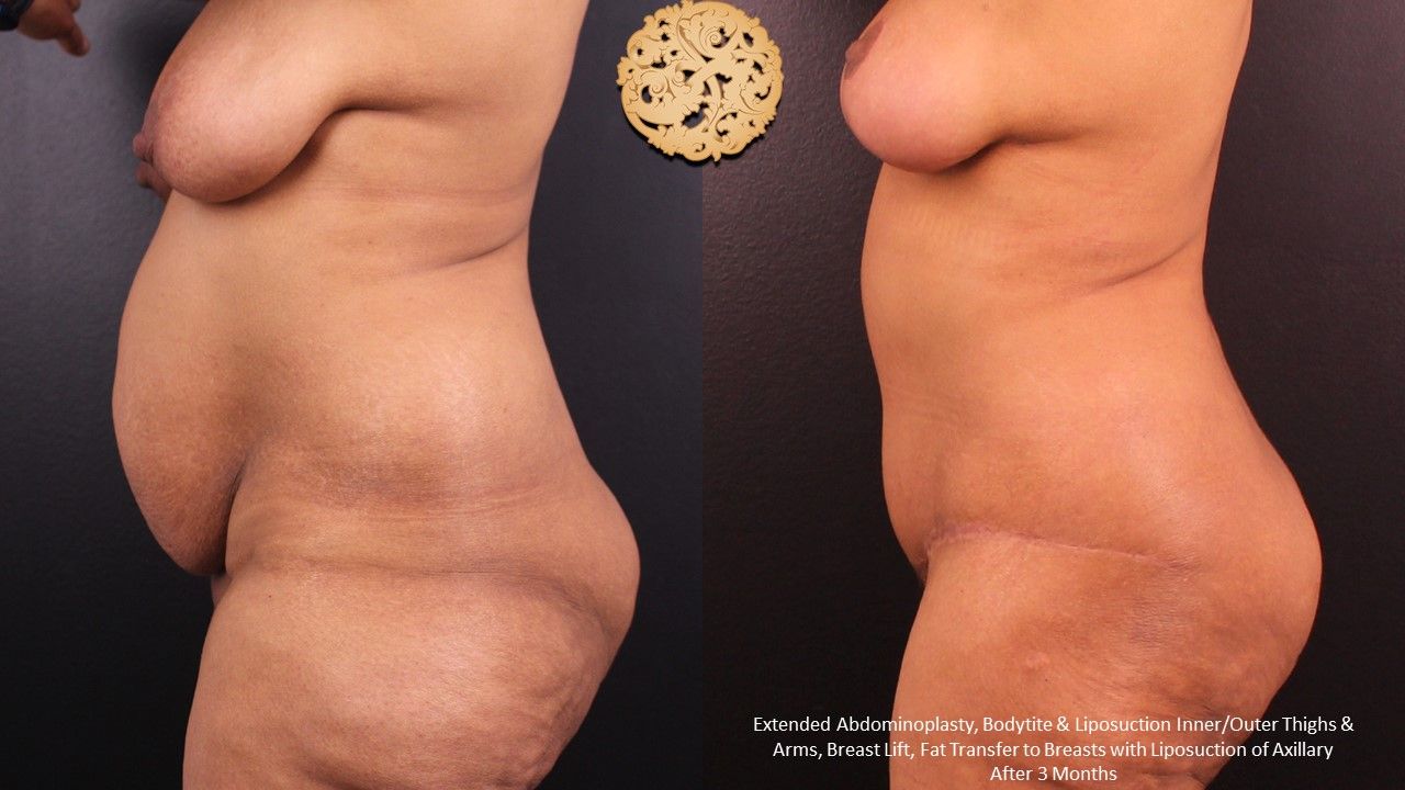 Tummy Tuck before and after - after