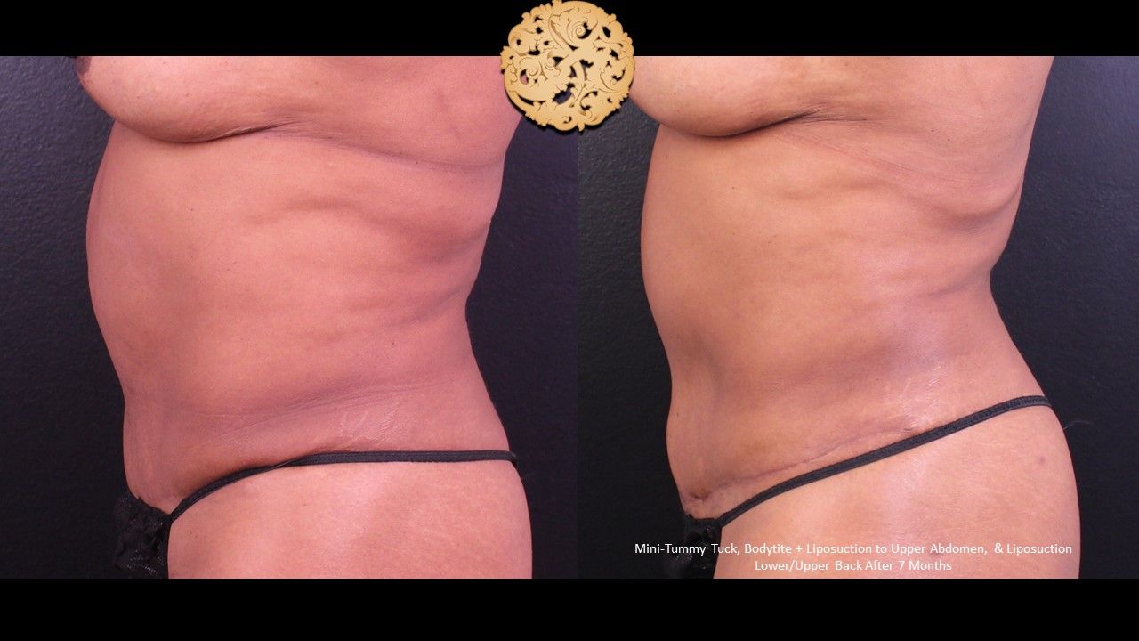 Tummy Tuck before and after - before