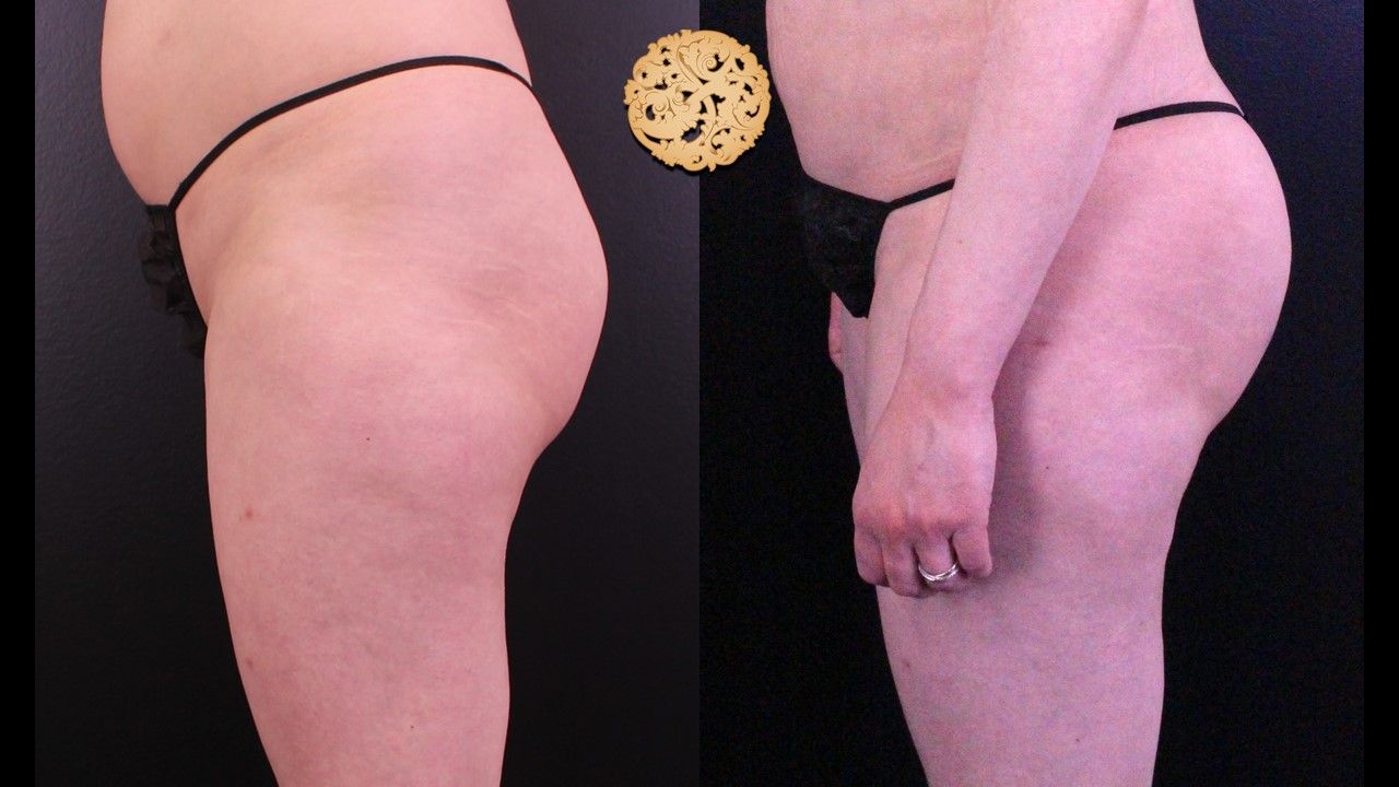Brazilian Butt Lift before and after - after