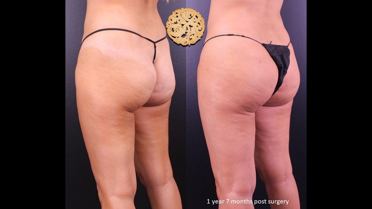 Brazilian Butt Lift before and after - before