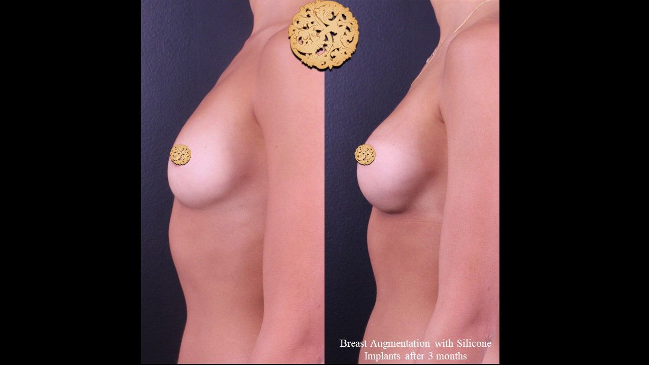 Breast Augmentation before and after - after