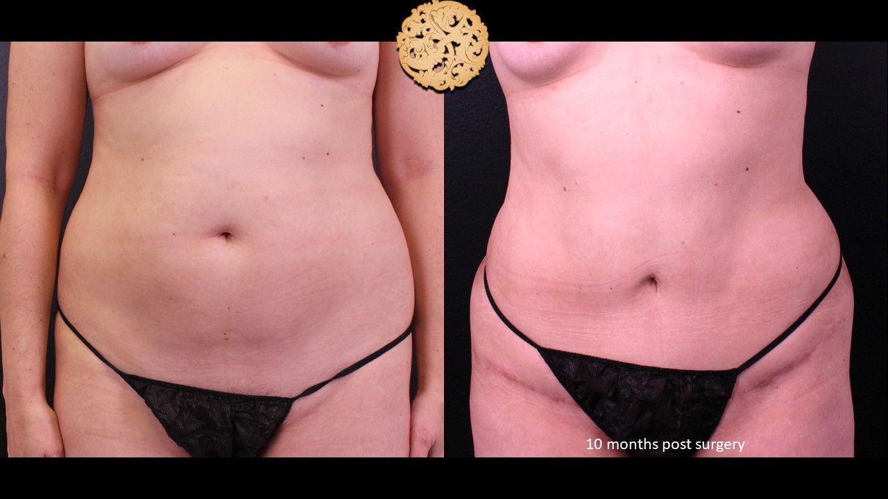 Mini Tummy Tuck before and after - before