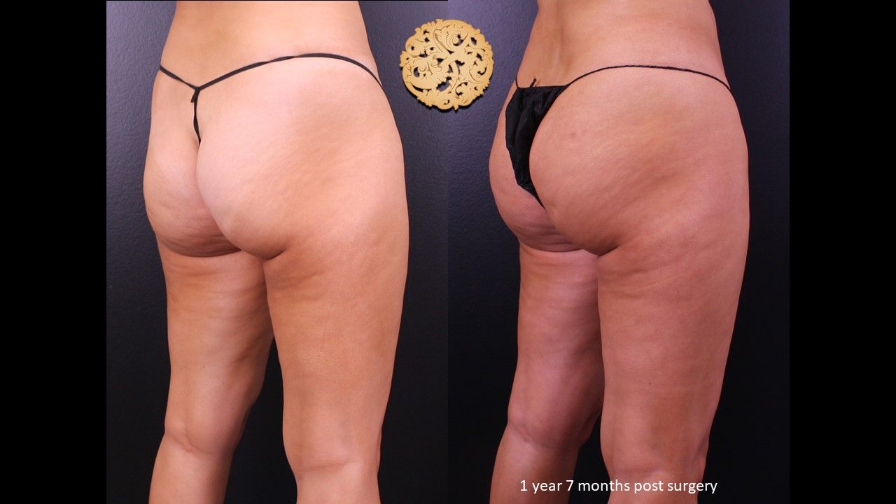 Brazilian Butt Lift before and after - after