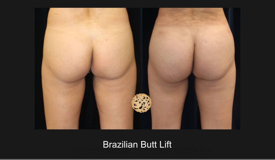 Brazilian Butt Lift before and after - before
