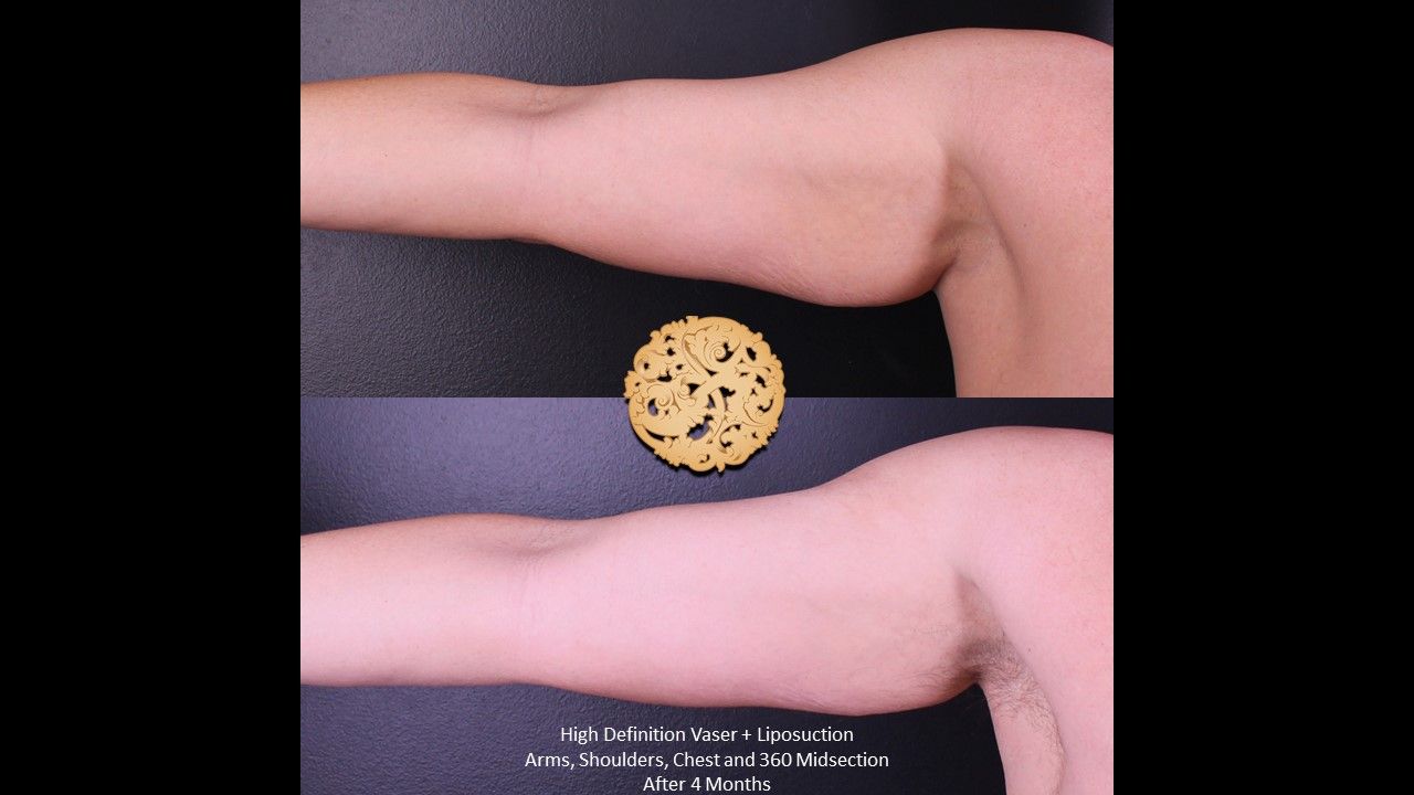 Liposuction before and after - after