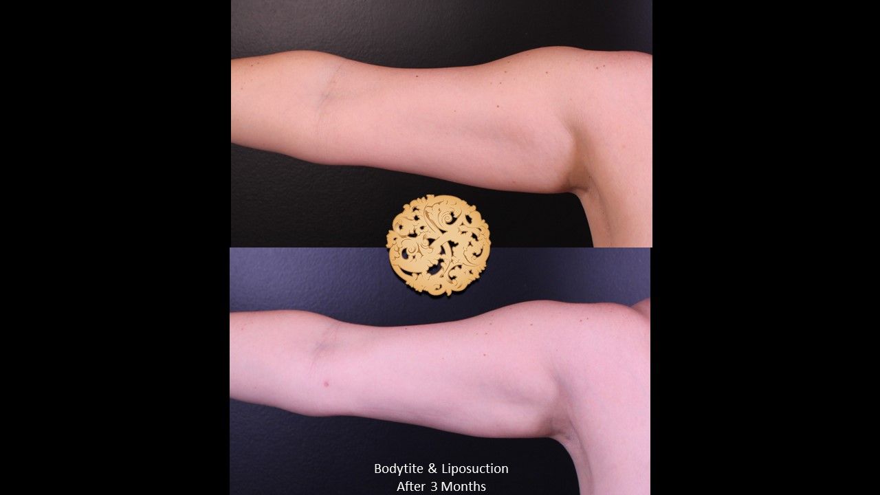 Liposuction before and after - before