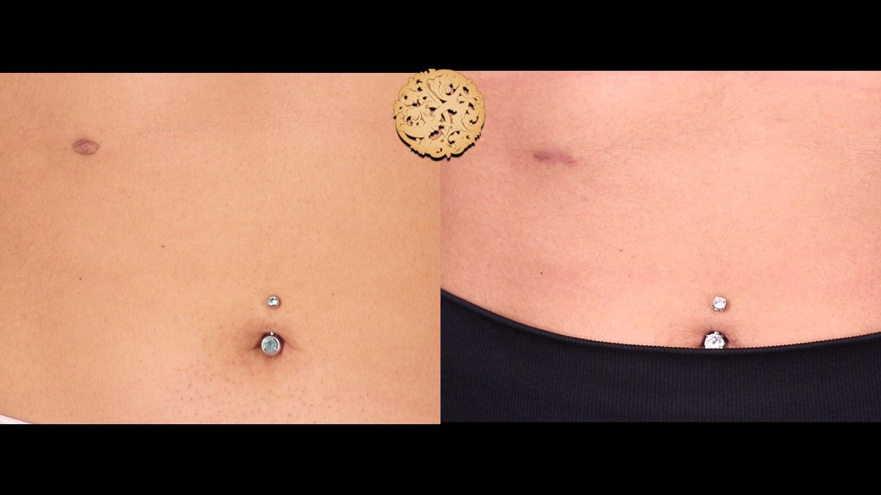 Accessory Nipple Removal before and after - after