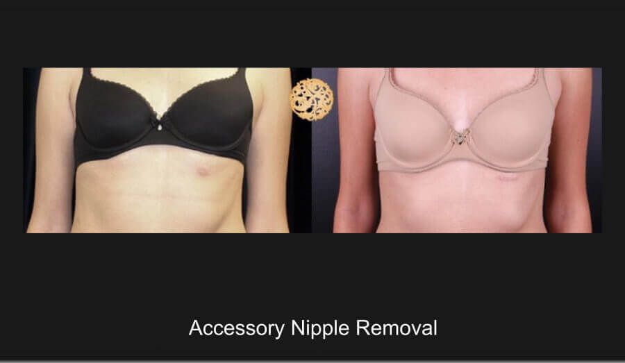 Accessory Nipple Removal before and after - before