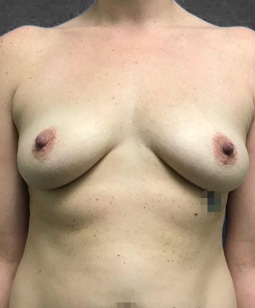 Breast Augmentation before and after - before