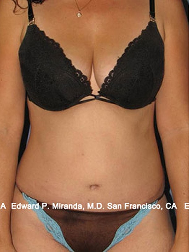 Tummy Tuck before and after - after