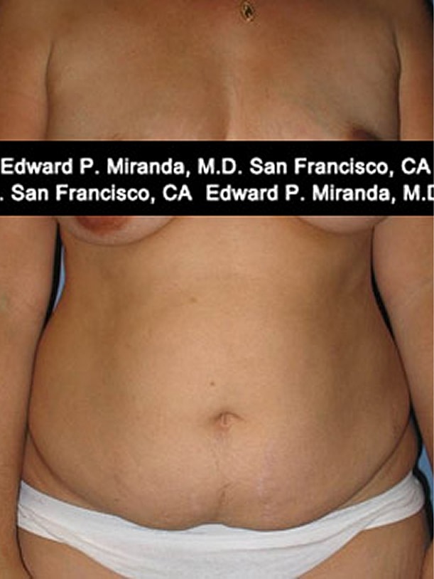 Tummy Tuck before and after - before