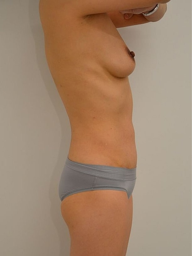 Tummy Tuck before and after - before