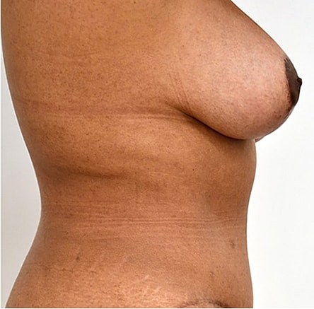 Breast Lift after — Dr. Edward Miranda