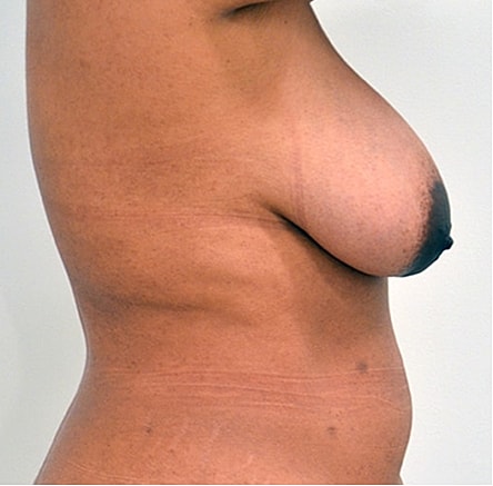 Breast Lift before — Dr. Edward Miranda