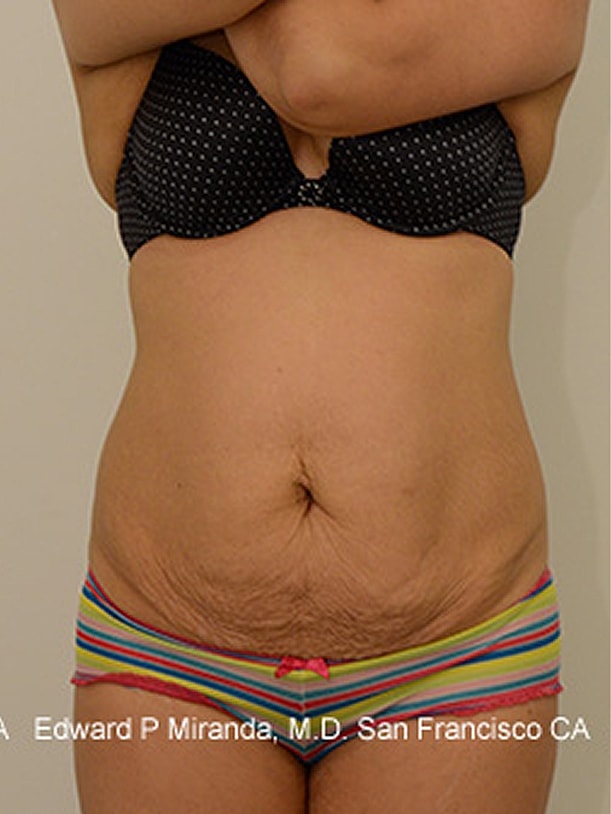 Tummy Tuck before and after - before