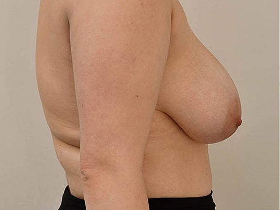 Breast Reduction before and after - before