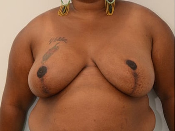 Breast Reduction before and after - after