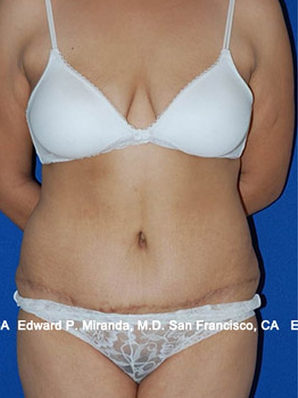 Tummy Tuck before and after - after
