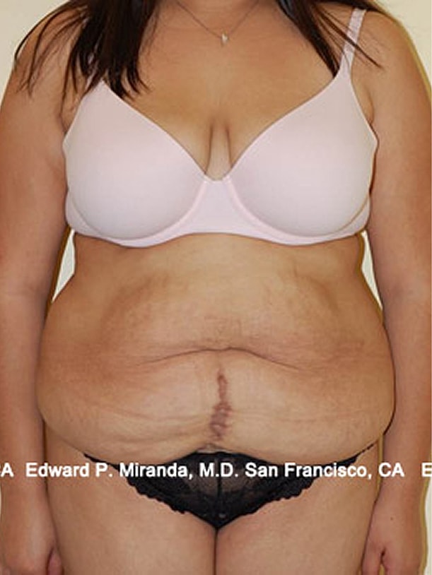Tummy Tuck before and after - before