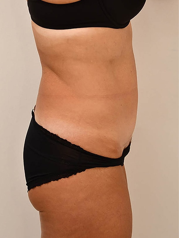 Tummy Tuck before and after - after