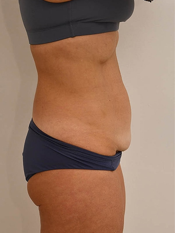 Tummy Tuck before and after - before