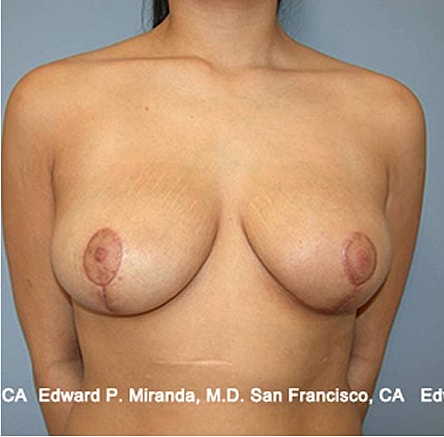 Breast Lift before and after - after