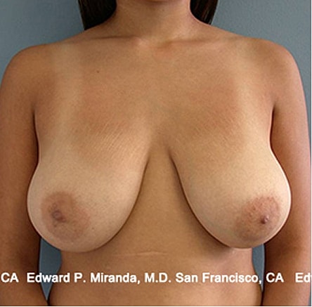 Breast Lift before and after - before