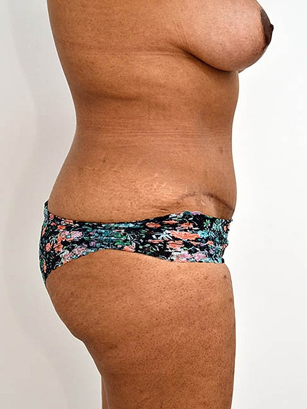 Tummy Tuck before and after - after