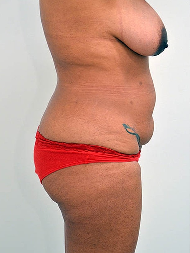 Tummy Tuck before and after - before