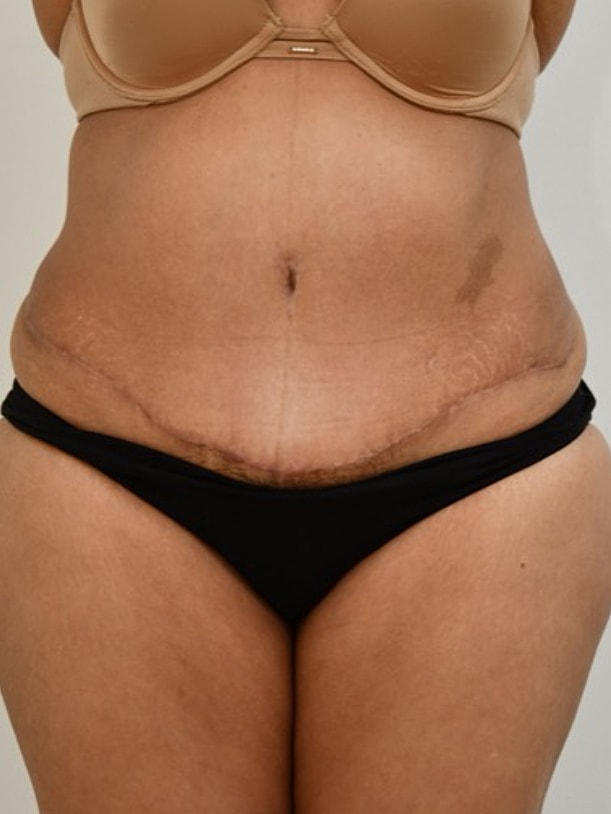 Tummy Tuck before and after - after